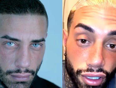 Francesco Chiofalo ricoverato d'urgenza in ospedale: «Disastro, non ci vedo bene»